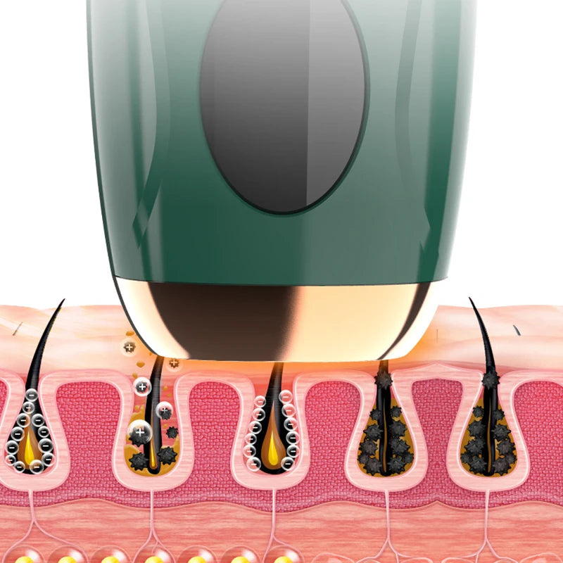 épilation au laser